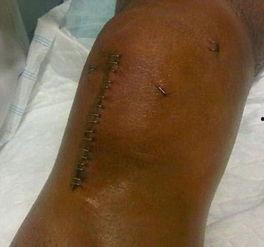 重创的伤口,揭秘重创伤口的康复历程